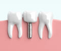 西梅田で歯の悩みを解決するならインプラント！矯正歯科をおすすめする人の特徴まとめ