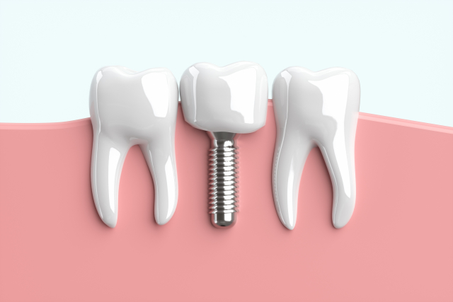 西梅田で歯の悩みを解決するならインプラント！矯正歯科をおすすめする人の特徴まとめ
